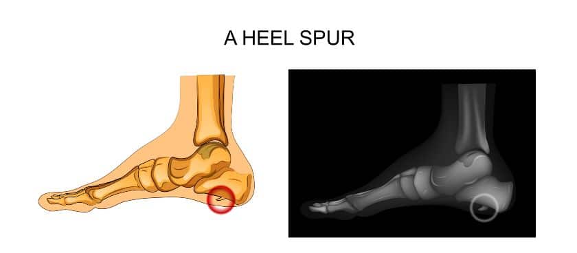 Heel Spurs anatomy