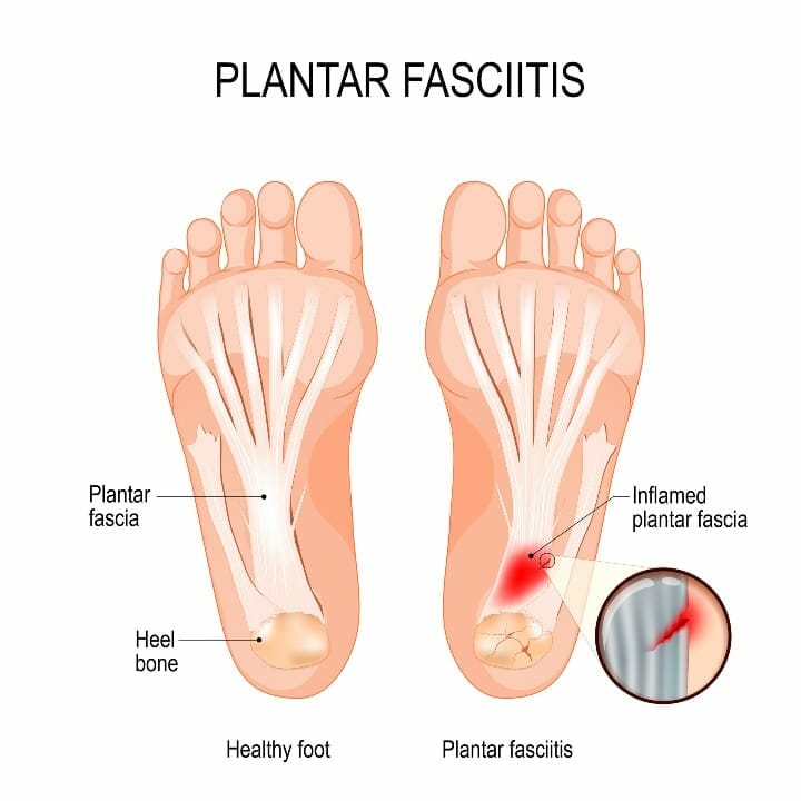 Plantar Fasciitis anatomy