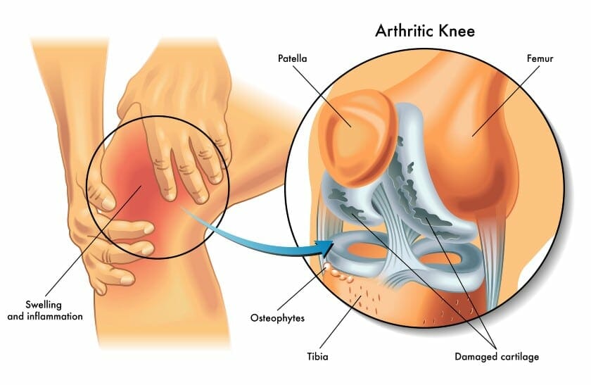 some common causes of Weak knees