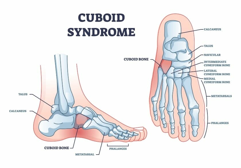 cuboid syndrome