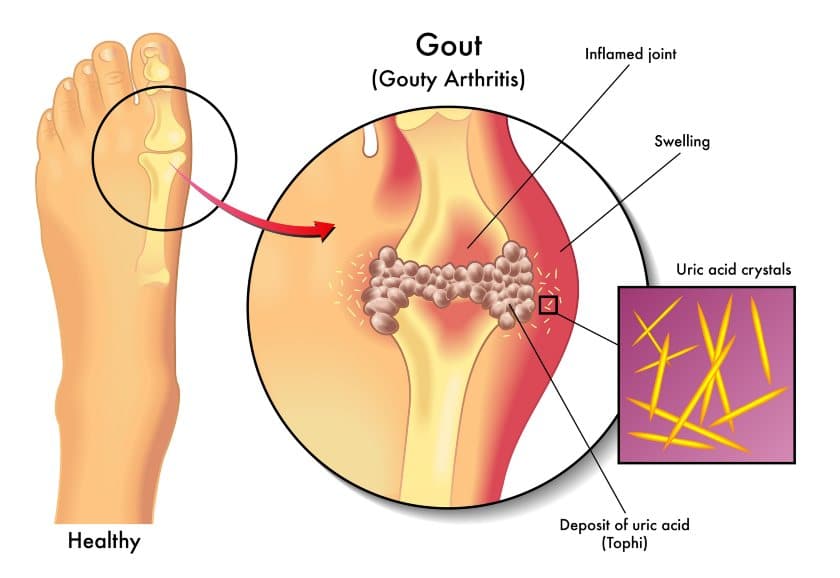 gout foot